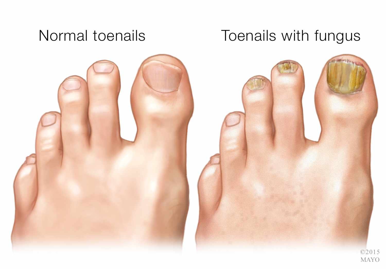 Healthy and Straight Nails